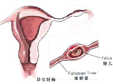 导致女性宫外孕的原因有哪些呢